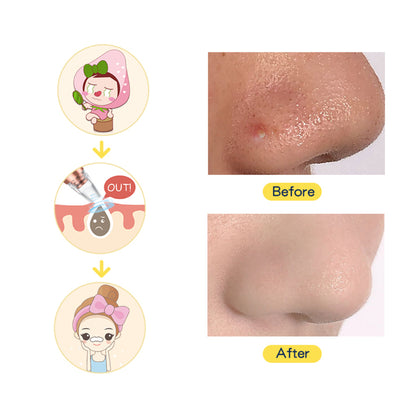 Multifunctional Blackhead Remover Machine